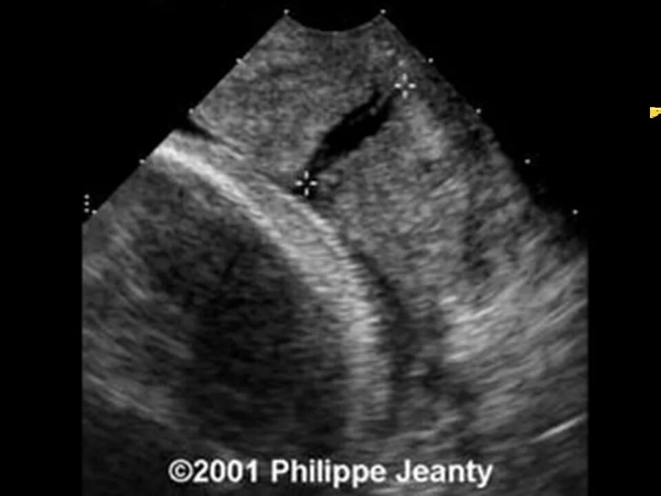 зев т образный