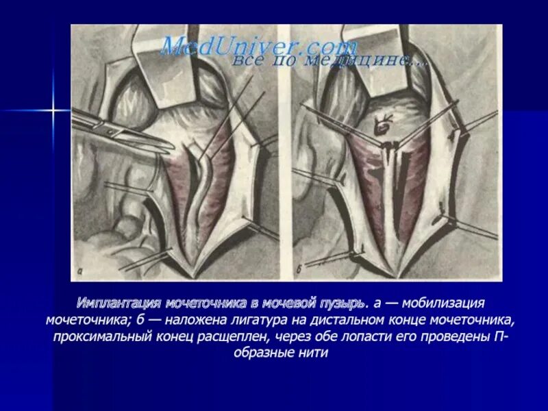 Мочеточник дистальный. Мобилизация мочеточников это. Имплантация мочеточника. Анатомия и физиология мочевой системы презентация. Уретероцистоанастомоз.