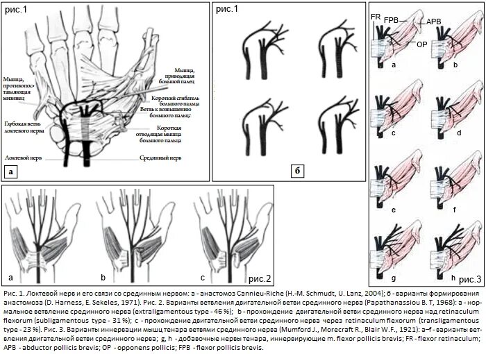 Иннервация 1 пальца кисти. Нейропатия лучевого нерва ЭНМГ. Возвратная ветвь срединного нерва. Нейропатия лучевого нерва тесты.