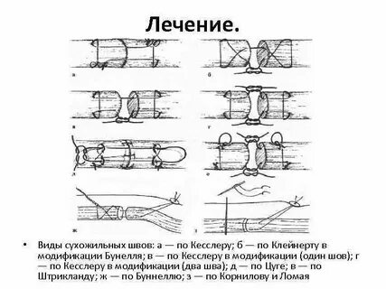 Шов сухожилия