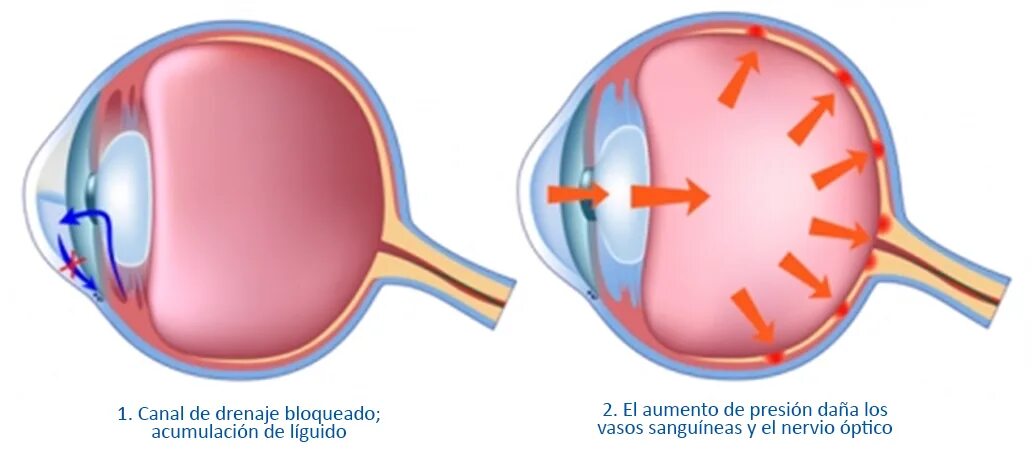 Схема глаза при глаукоме. Здоровый глаз и глаукома.