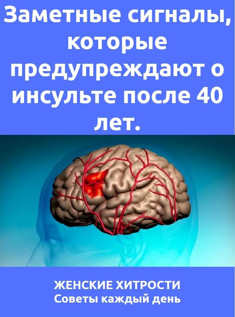 Инсульт. Предупреждающие сигналы организма об инсульте. Точечный инсульт.