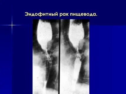 Эндофитная опухоль