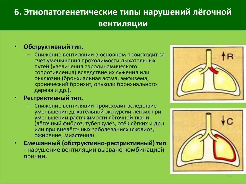 Типы нарушения легочной вентиляции. Нарушение легочной вентиляции по обструктивному типу. Обструктивный Тип нарушения легочной вентиляции. Типы нарушения вентиляции легких. Нарушение легких по обструктивному типу