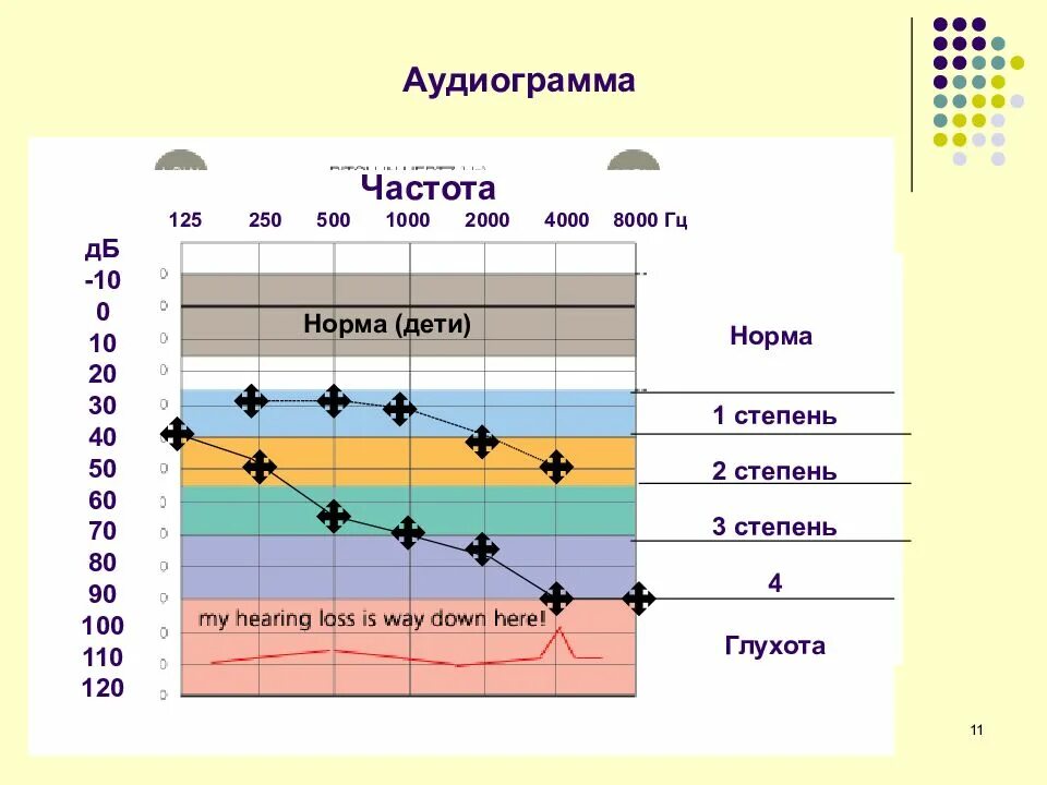 Аудиограмма норма. Аудиограмма 1 степени тугоухости. Аудиограмма слуха 3 степени. Аудиограмма слуха расшифровка таблица. Аудиометрия тугоухость 1 степени.