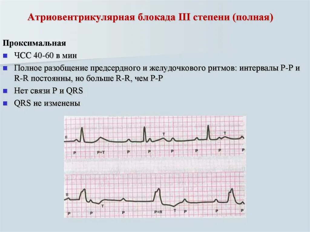 Предсердная блокада. Блокада 3 степени сердца ЭКГ. Полная атриовентрикулярная блокада 3 степени на ЭКГ. Полная АВ блокада на ЭКГ. ЭКГ при АВ блокаде 3 степени.