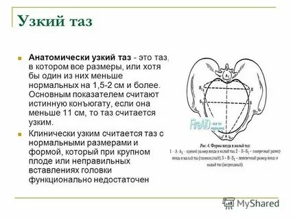 Узкой род
