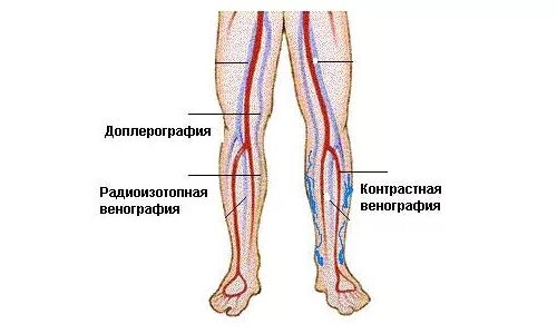 Тромбофлебит вен мкб. Воспаление вен нижних конечностей. Ультразвуковая анатомия вен нижних конечностей.