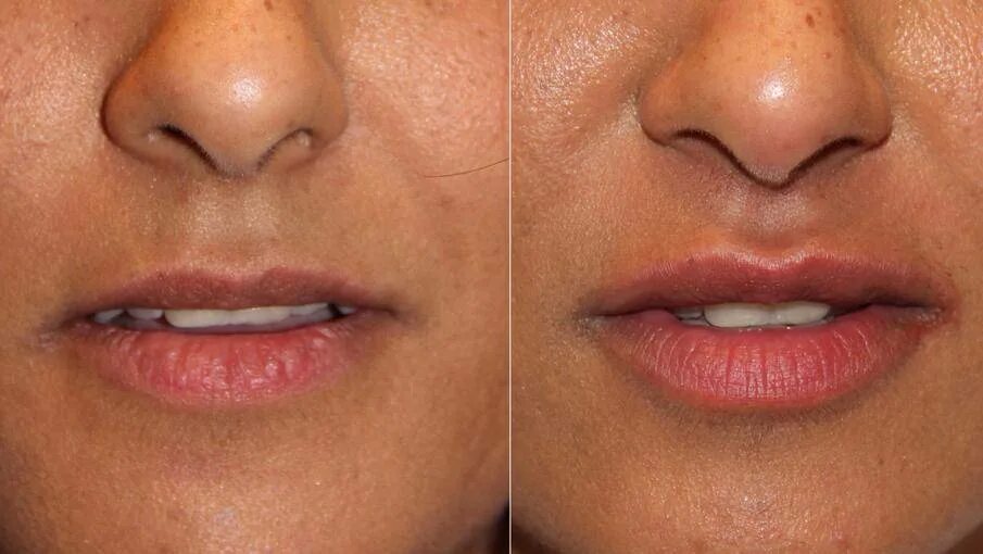 Небольшая коррекция губ. Увеличить верхнюю. Узкие губы. Губы с 1 мл гиалуроновой кислоты до после. Увеличить верхнюю.
