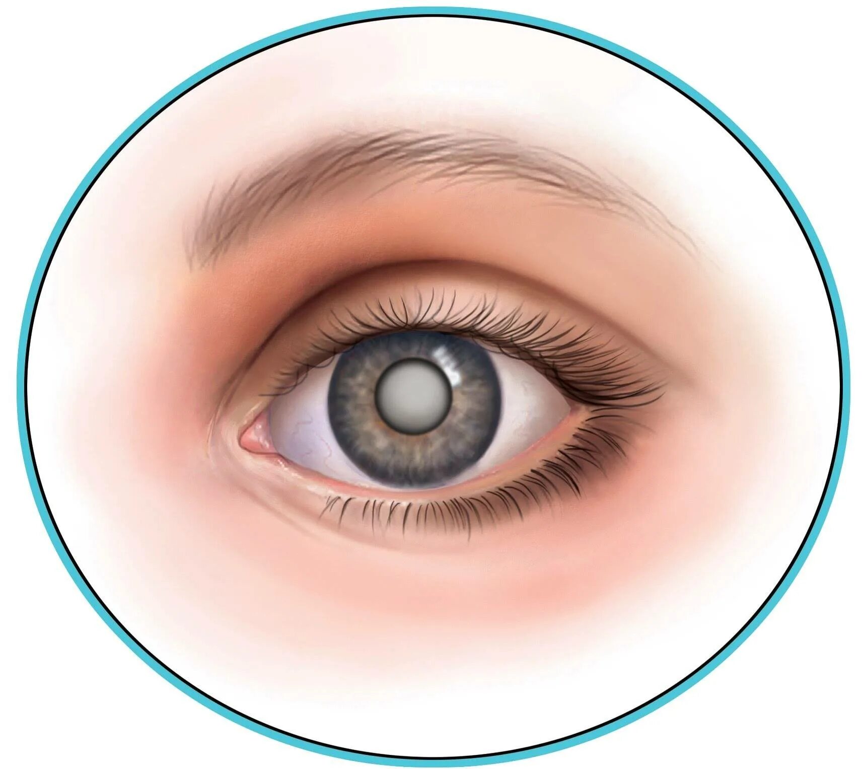 Глаза пробужденного. Катаракта помутнение хрусталика. Глазная болезнь катаракта. Катаракта глаза симптомы.