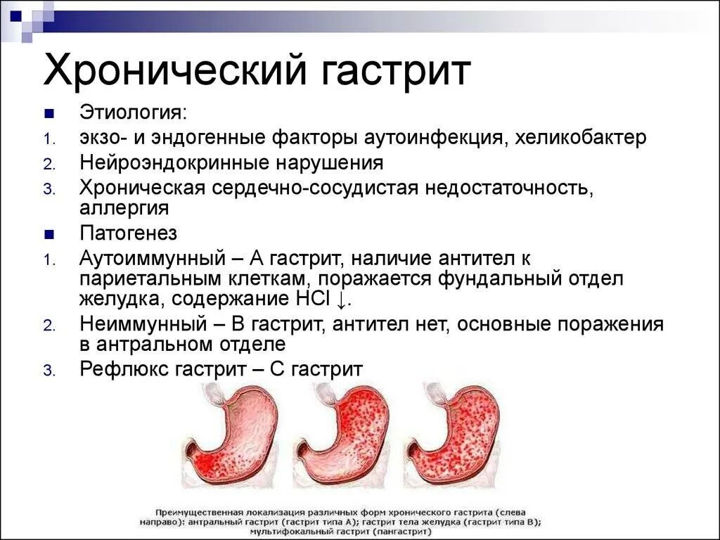 Патогенез хронического гастрита хеликобактер пилори. Антральный гастрит синдром. Хронический антральный гастрит. Фундальный гастрит симптомы. Локализация язвы желудка