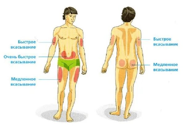 укол инсулина. куда колоть длинный. схема чередования мест инъекций инсулина. анатомические области введения инсулина. зоны куда колоть инсулин.