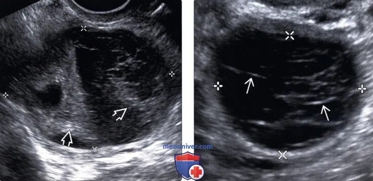 Апоплексия кисты яичника на УЗИ. Геморрагическая апоплексия яичника. Фолликулярная киста яичника на УЗИ. Киста яичника orads