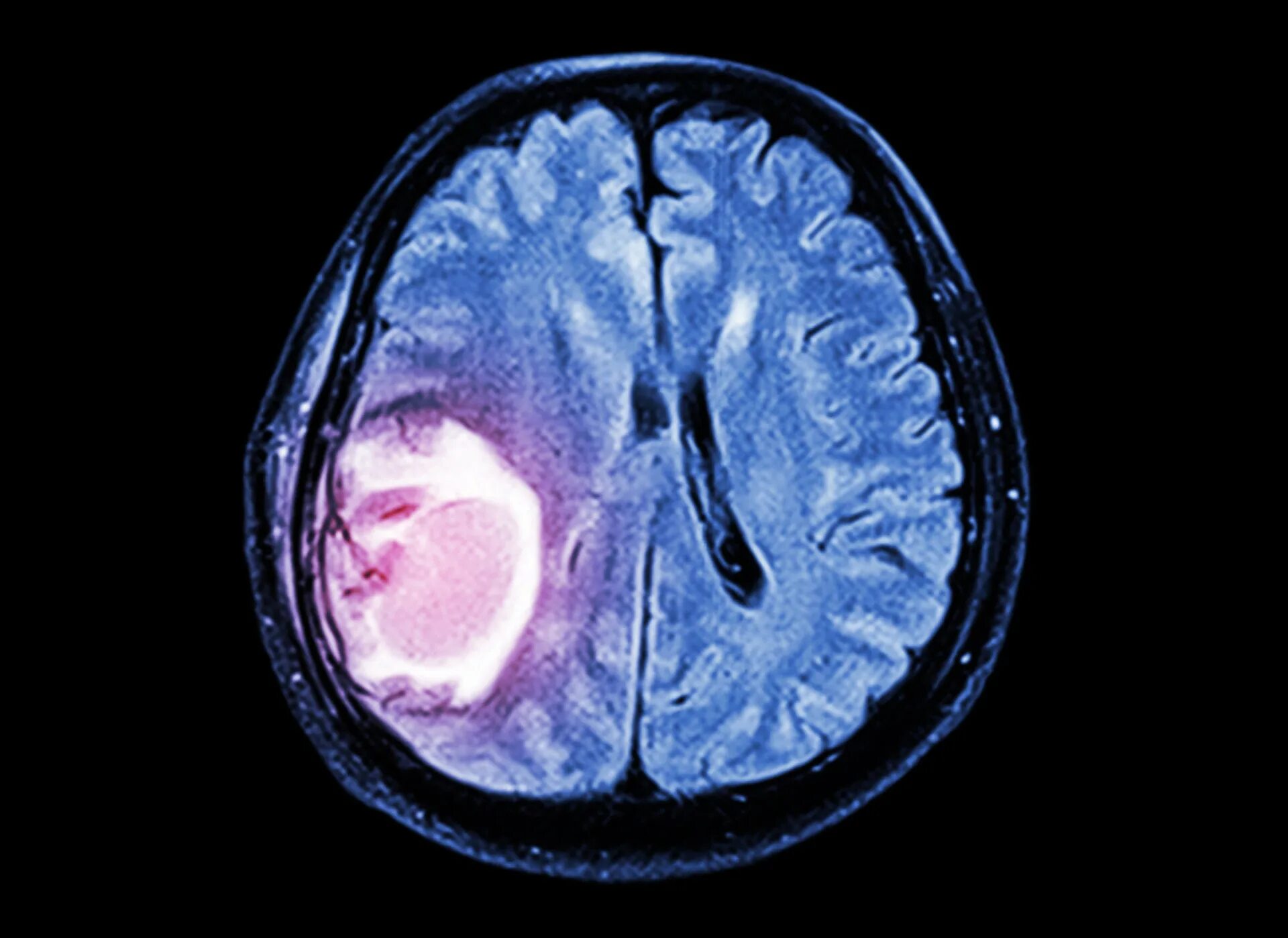 Глиобластома головного мозга. Раковая опухоль головного мозга. Опухоль головного глиома. Опухоль головного мозга тератома.
