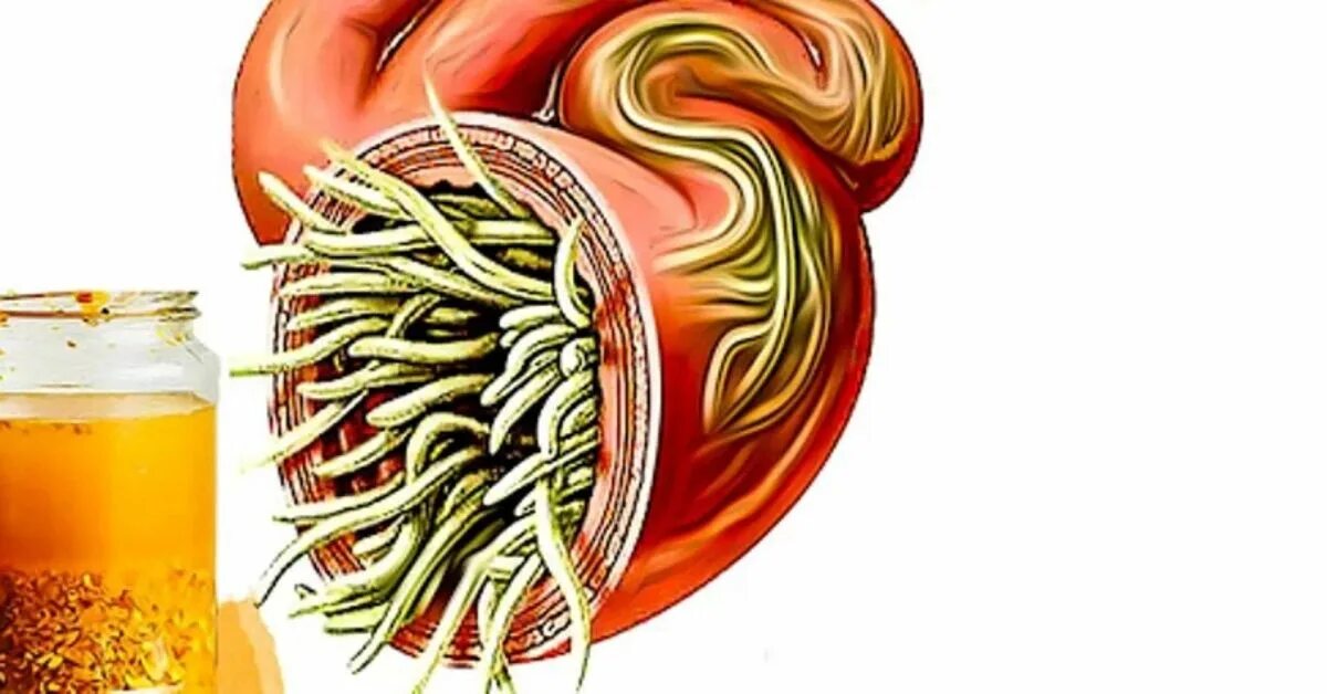 Очищения кишечника от паразитов гельминтов. Китайская медицина от глистов. Народное средство от кишечных паразитов. Очистки организма от паразитов