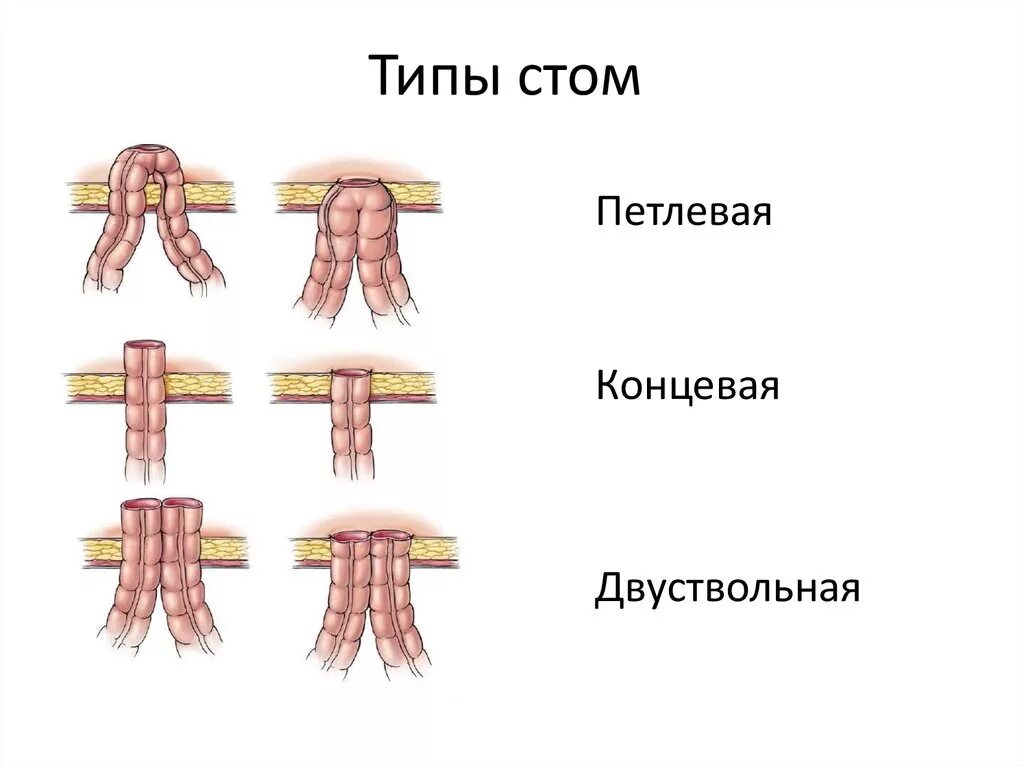 Типы стом. Двуствольная илеостома. одноствольная и двуствольная колостома.