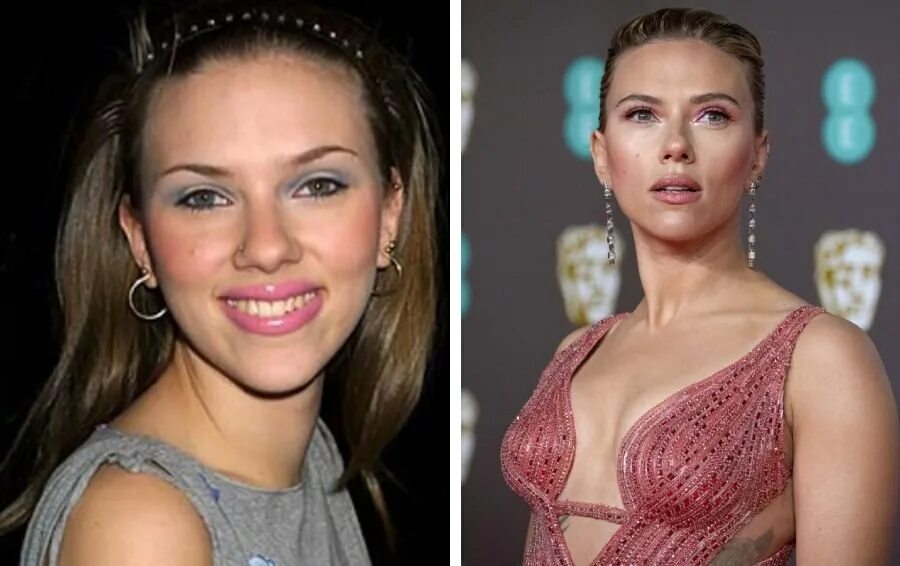 Йоханссон до и после операции SCARLETT JOHANSSON: Before and After Plastic Surgery YouTube