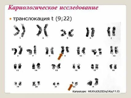 Кариотип транслокации
