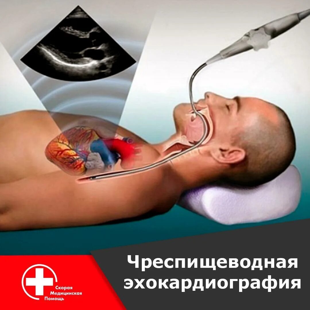 Чп экг