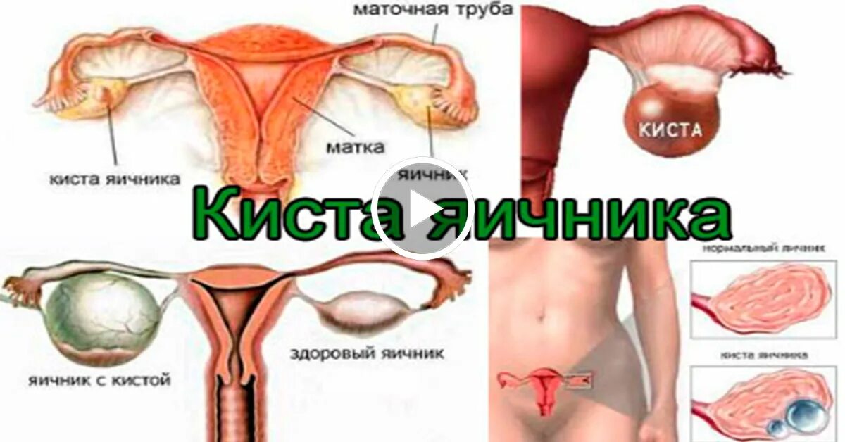 Где болят яичники фото. Симптомы кичтомы яичника. Где болят яичники фото. Где болят яичники фото. Где болят яичники фото.
