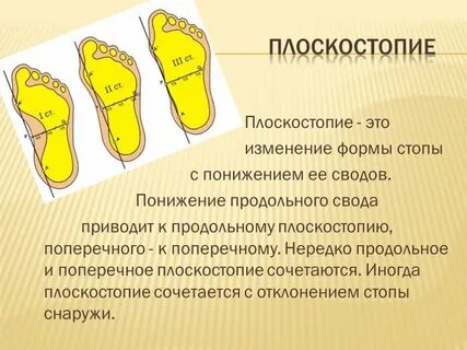 Что означает плоскостопие москва