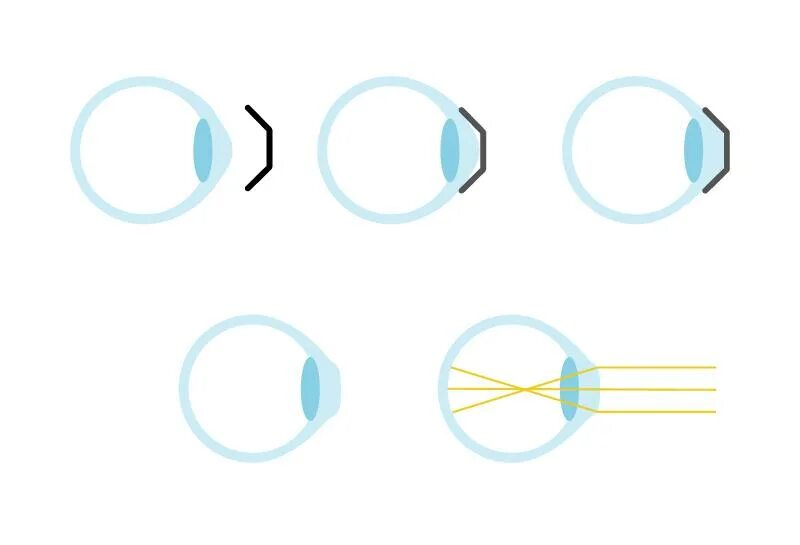Жёсткие линзы для коррекции зрения. Жесткие контактные линзы схема. Ночные линзы. Линзы ночные для коррекции зрения.