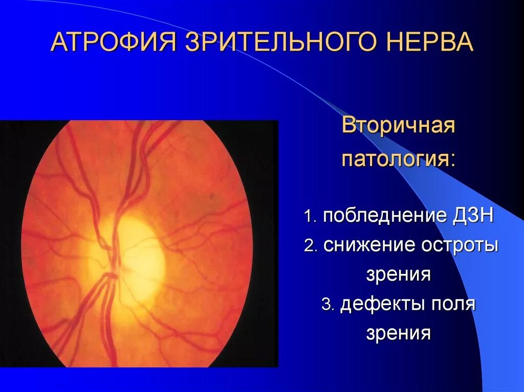Размеры зрительных нервов. Атрофия зрительного нерва. Атрофия диска зрительного нерва. Патология диска зрительного нерва. Вторичная атрофия зрительного нерва.
