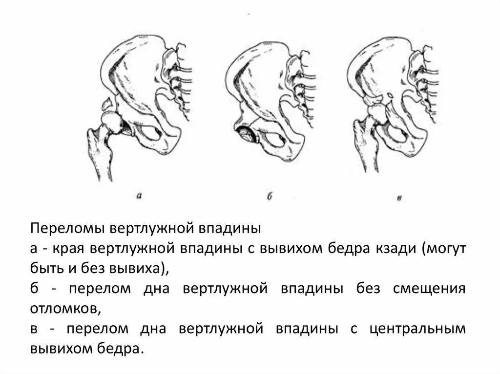 Передний верхний край. Переломы дна или краев вертлужной впадины. Импрессионный перелом вертлужной впадины. Перелом вертлужной впадины класси. Перелом вертлужной впадины тазобедренного.