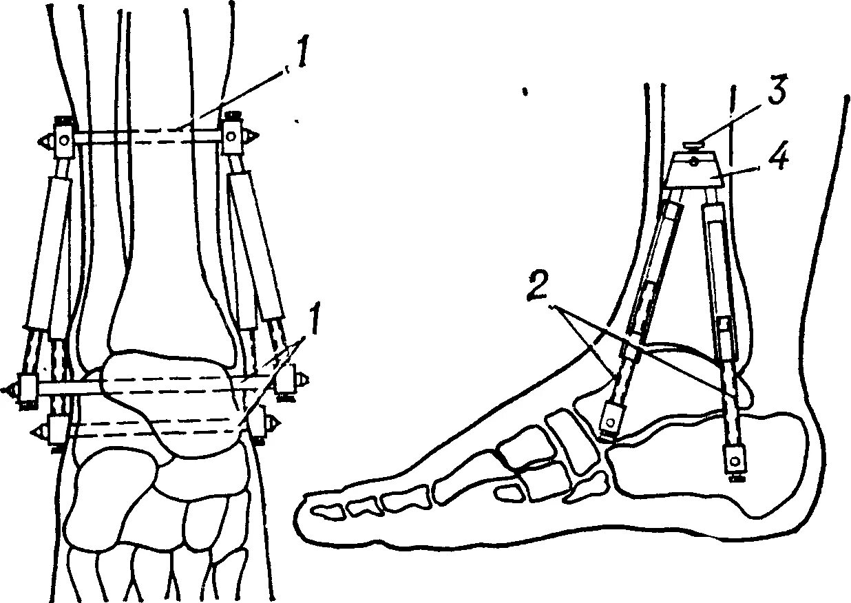 Аппарат Елизарова ортродез коленного сустава. Артродез голеностопного сустава аппаратом Илизарова. Операция артродез голеностопного сустава. Артродез коленного сустава с аппаратом Илизарова. Артродез суставов операция