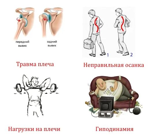 Боль в руке при поднятии и отведении. При поднятии руки больно в плече. Боль при подъеме руки вверх в плече. Боль в плече при поднятии руки вверх причины. Болит плечевой сустав левой руки при поднятии руки вверх.