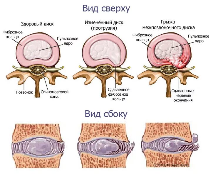 Болит ли протрузия. Грыжи и протрузии позвоночника. Протрузия дисков позвоночника что это такое. Протрузия дисков позвоночника и грыжа. Грыжа диска и протрузия диска.