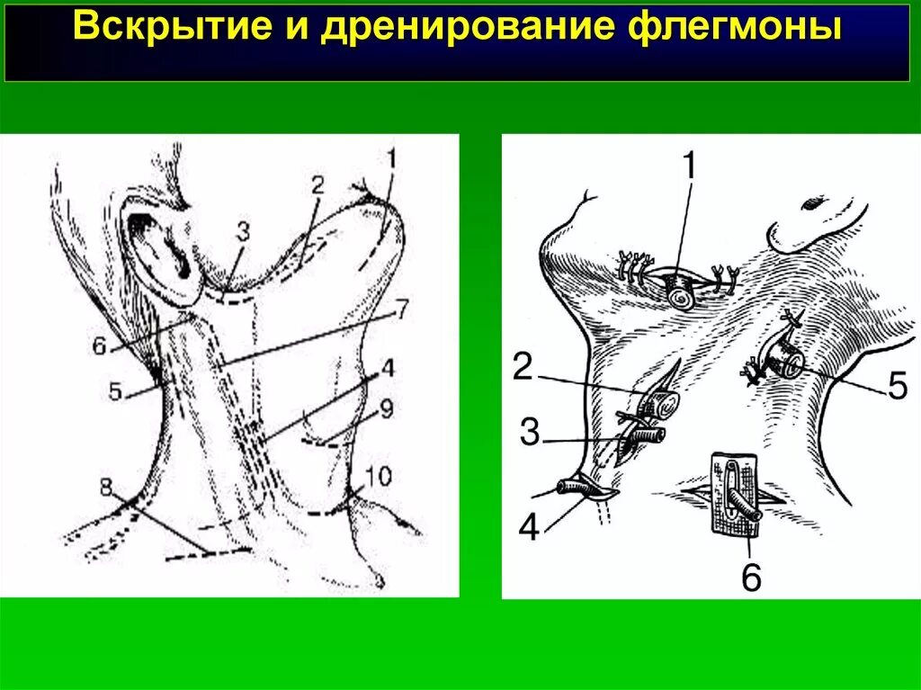 Разрезы для вскрытия абсцессов шеи. Флегмона дна полости рта разрез. Оперирование флегмоны. Дренирование при флегмоне.