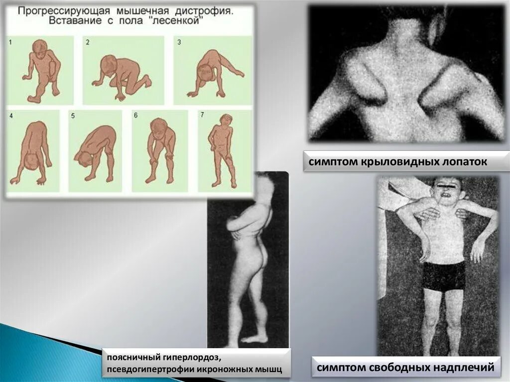 Клиническая миопатия. Конечностная мышечная дистрофия. Мышечная дистрофия конечностно поясная форма. Прогрессирующая мышечная дистрофия Беккера симптомы.
