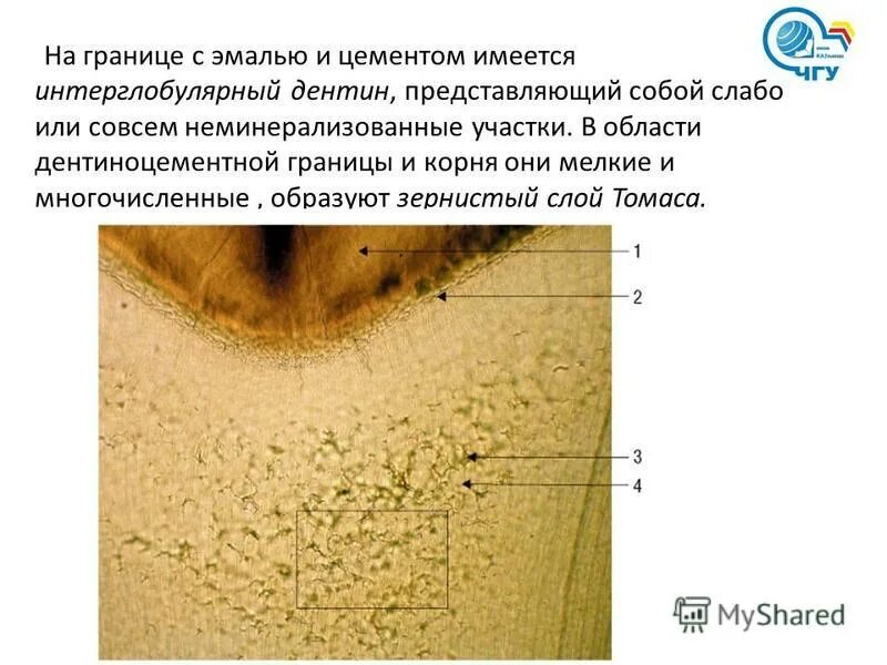 Зернистый слой дентина. Глобулярный и интерглобулярный дентин. Интерглобулярный дентин минерализация. Глобулярный дентин и интерглобулярный дентин. Интерглобулярный дентин.