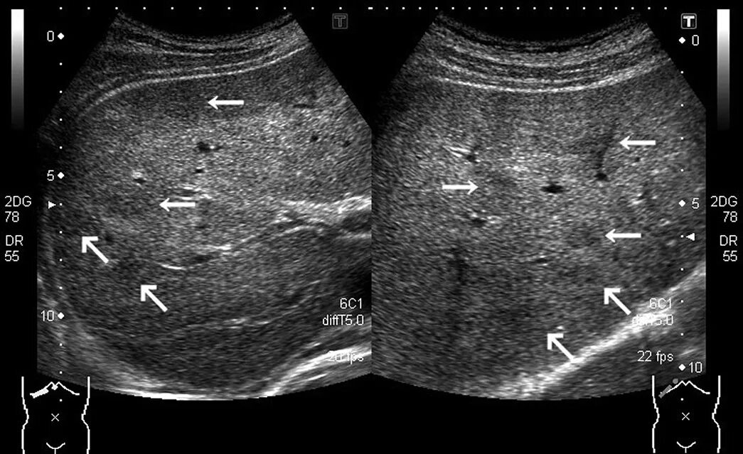 Описторхоз в желчных путях. Глисты в желчном пузыре узи. Токсокароз в печени на узи. Аскаридоз желчного пузыря узи. Описторхоз характерные клинические проявления.