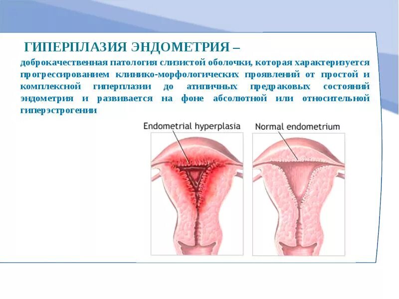 Гиперплазия эндометрит. Ультразвуковые критерии гиперплазии эндометрия. Гиперплазия эндометрия матки что это. Эндометрия матки симптомы лечение