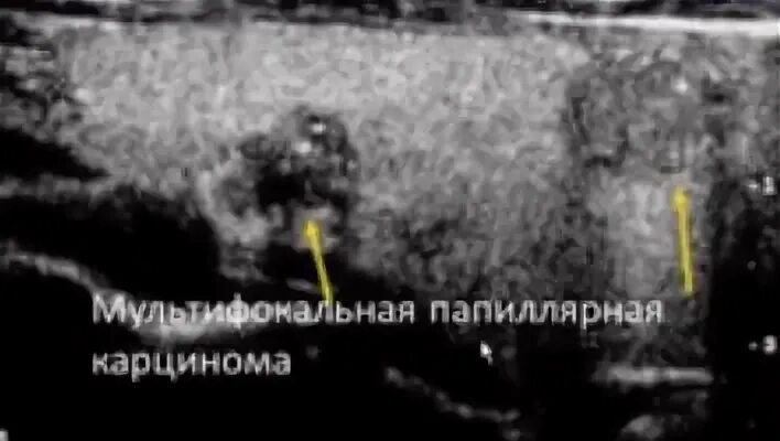 Нечеткие контуры щитовидной железы что это значит. Изоэхогенный узел щитовидной железы на узи. Эхограммы узлы щитовидной железы. Эхоструктура неоднородная щитовидной железы что это такое. Нечеткие контуры щитовидной.