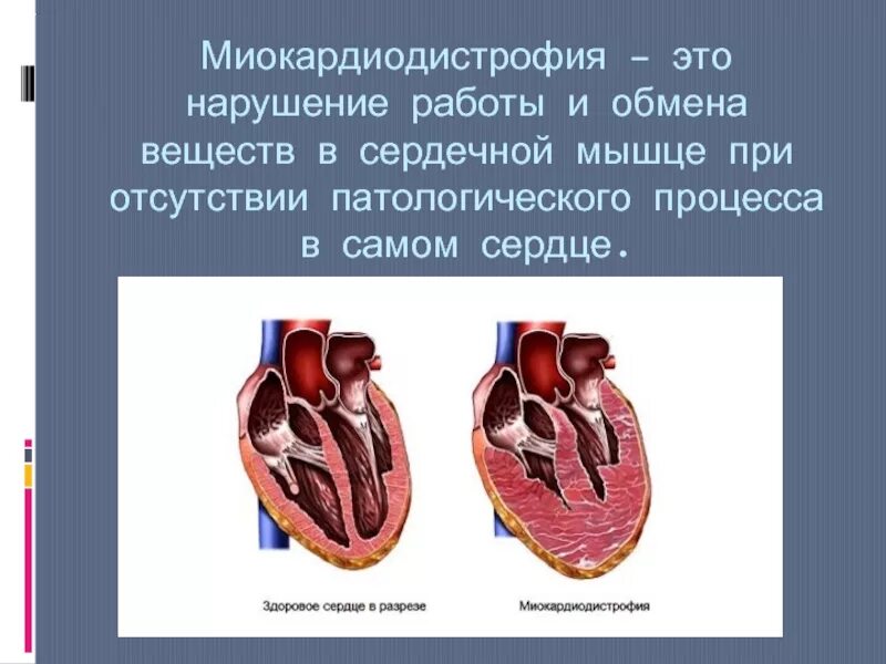 Заболевания мышц сердца