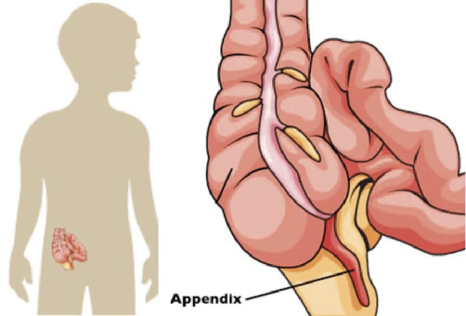 Что делает аппендикс. Червеобразный отросток у детей. Воспаленный аппендикс.