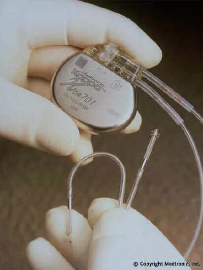 Если стоит кардиостимулятор можно. Частотно-адаптивный двухкамерный кардиостимулятор. Электрокардиостимулятор имплантируемый. Двухкамерный кардиостимулятор. Двухкамерный кардиостимулятор сердца.