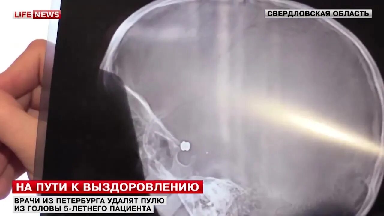 Пуля остановилась в 3 мм от мозга. Пуля остановилась в 3 мм от мозга. Пуля остановилась в 3 мм от мозга. Пережить выстрел в голову. Пуля остановилась в 3 мм от мозга.