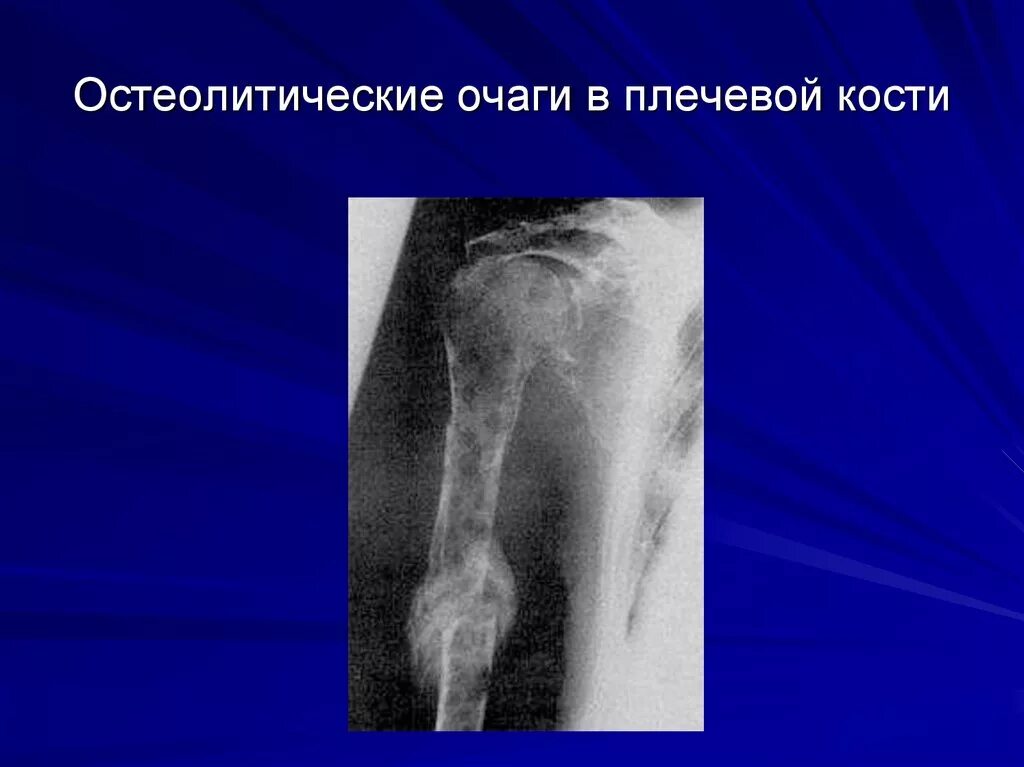 Вторичное поражение костей. Остеолитическая деструкция кости что это. Остеолитические метастазы рентген. Остеолитические метастазы в кости. Рентгенодиагностика остеобластических метастазов.