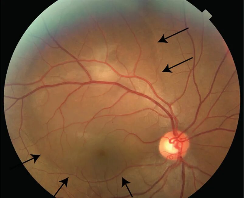 Микроаневризмы сетчатки. Микроаневризмы сосудов сетчатки. Анемическая ретинопатия. Гипертензивная ретинопатия.