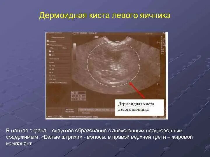 Образование округлое в яичнике