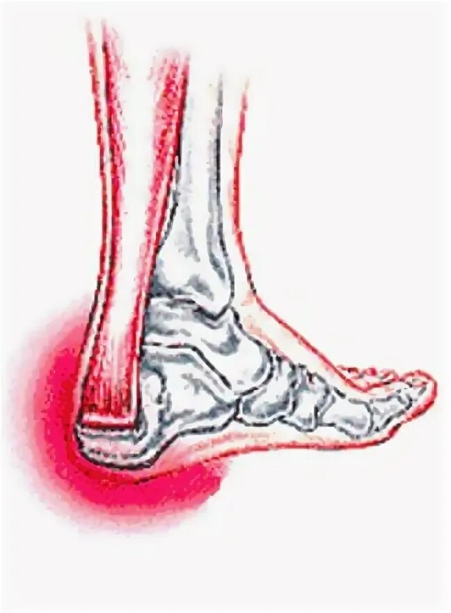 Воспаление ахиллесова сухожилия тендинит. Тендинит пяточного ахиллова. Тендинит пяточного ахиллова сухожилия. Тендопатия ахиллесова сухожилия.