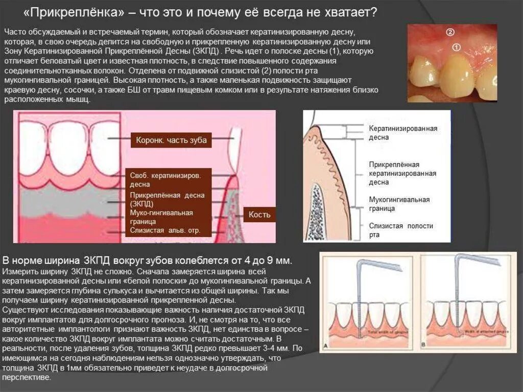 Прикрепленная Десна и кератинизированной. Зона кератинизированной десны. Ширина кератинизированной десны. Ширина зоны кератинизированной десны.