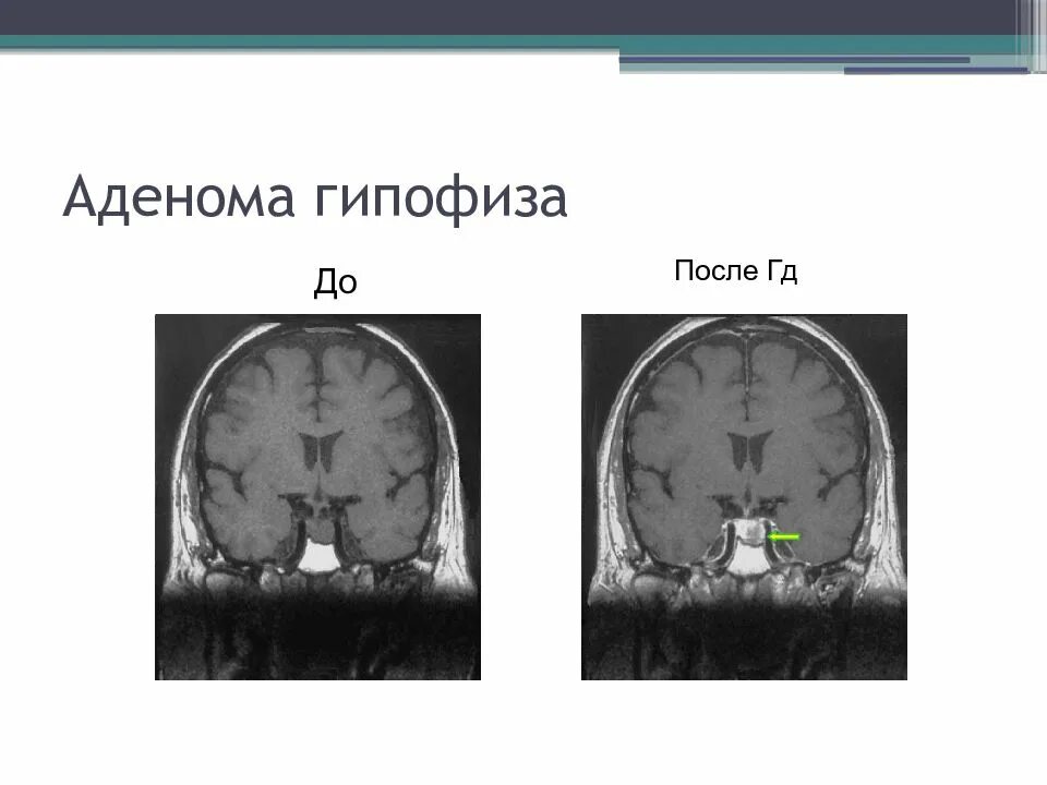 Изменения гипофизе. Микроаденома гипофиза кт. Аденома гипофиза мрт. Аденома гипофиза кт. Микроаденома гипофиза мрт.