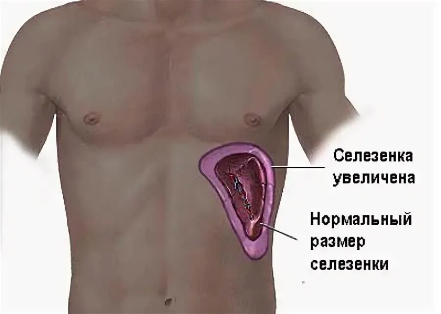 Расширенная селезенка. Селезенка расположение в организме. Где находится селезенка у человека. Селезенка место расположения.