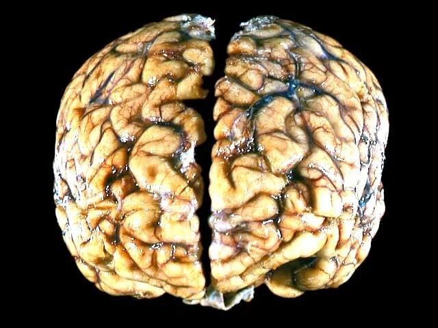 Человеческий мозг живой. Brain disease