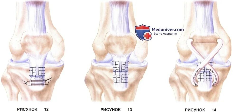 Шов собственной связки надколенника. Разрыв собственной связки надколенника операция. Пластика собственной связки надколенника. Сшивание связки надколенника. Перелом надколенника операции